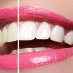Restorative dentistry treatment in London