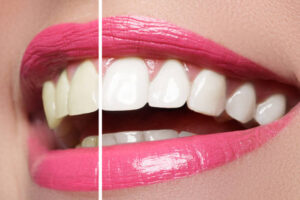 Restorative dentistry treatment in London